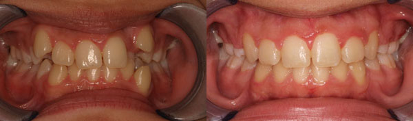 Patient smile before and after orthodontic treatment at Straight Finish Orthodontics, case 5