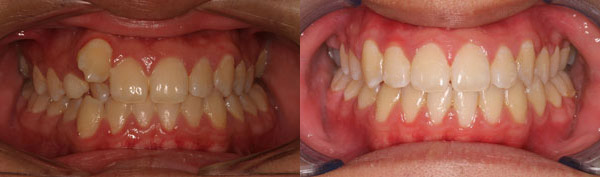 Patient smile before and after orthodontic treatment at Straight Finish Orthodontics, case 6