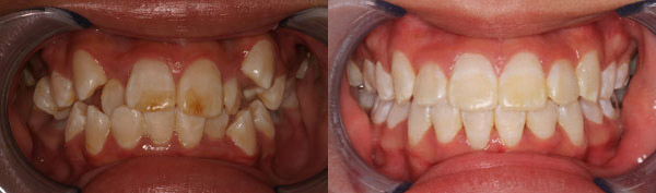Patient smile before and after orthodontic treatment at Straight Finish Orthodontics, case 7