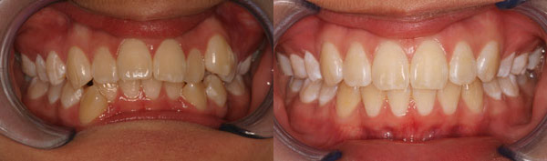 Patient smile before and after orthodontic treatment at Straight Finish Orthodontics, case 8