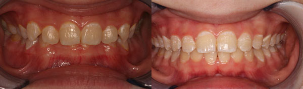 Patient smile before and after orthodontic treatment at Straight Finish Orthodontics, case 9