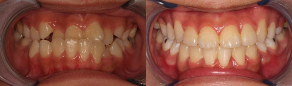 Patient smile before and after orthodontic treatment at Straight Finish Orthodontics, case 10