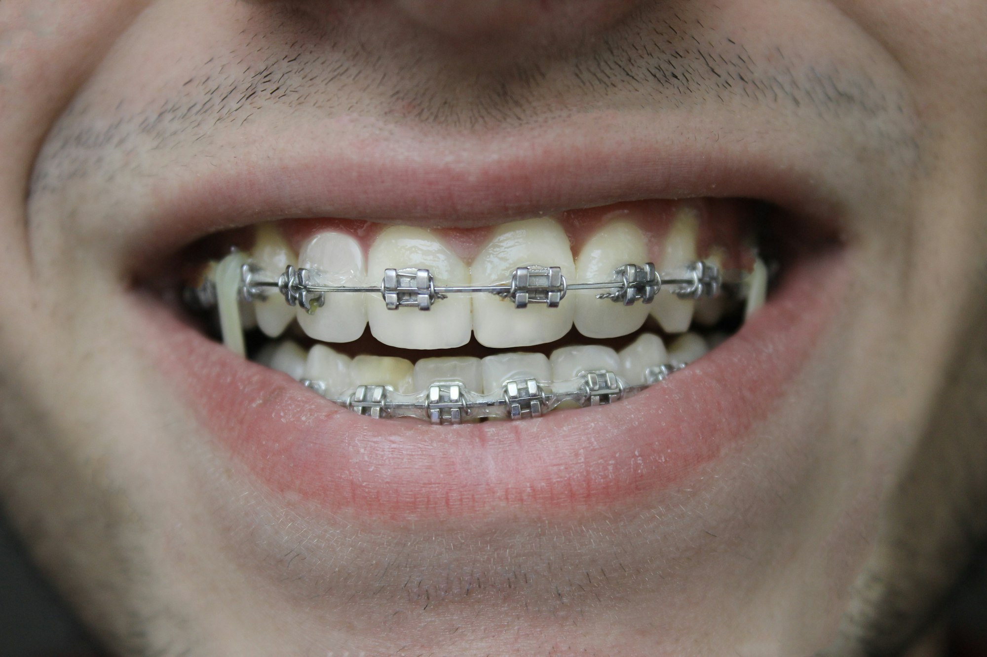 Close-up of a smile with metal braces on the upper and lower teeth