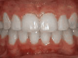 After treatment