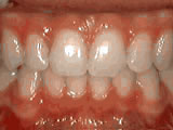 After treatment