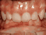 Before treatment