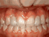 After treatment