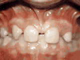Before treatment