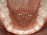 After treatment