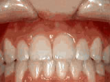After treatment