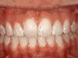 After treatment