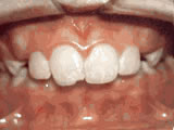 Before treatment