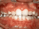 After treatment