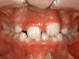 Before treatment