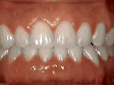 After treatment