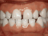 Before treatment