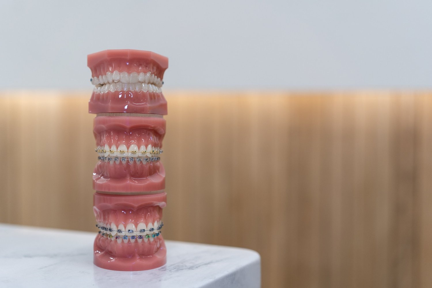 Dental models showing braces and a clear aligner