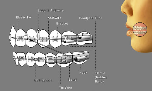 Diagram of upper and lower braces showing the archwire running through brackets on each tooth, with a headgear tube at the back and an elastic connecting the two arches.