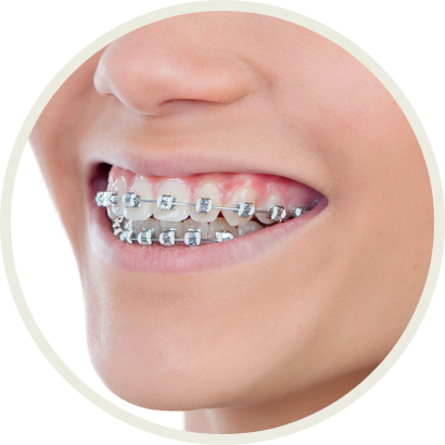 Close-up of a smile wearing metal braces on the upper and lower teeth